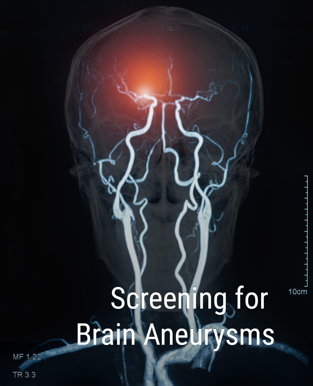 Screening for Brain Aneurysms
